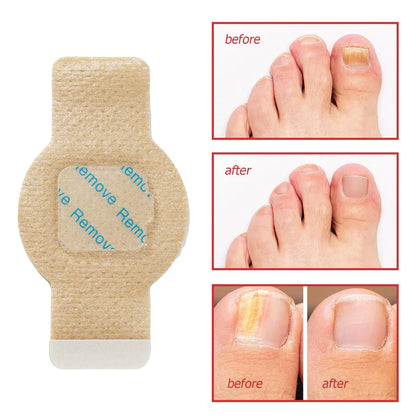 NailHeal™ - Fungal Nail Patches 🌿💅 ( Buy 1 Get 1 Free🔥)