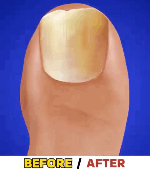 NailHeal™ - Fungal Nail Patches 🌿💅 ( Buy 1 Get 1 Free🔥)